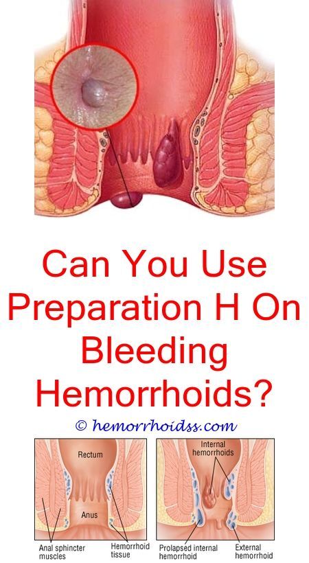 How do you know when you have a hemorrhoid?.Do hemorrhoids ever pop ...