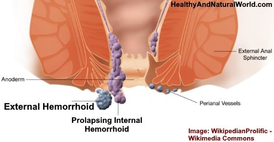 How Long do Hemorrhoids Last and How to Recover Faster ...