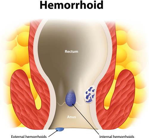 How Long Do Hemorrhoids Last? How to Make Them Go Away Fast?