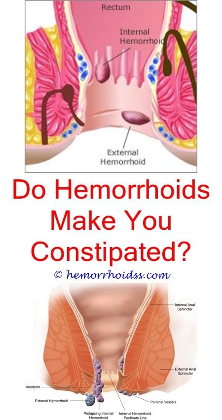 How Long Do Hemorrhoids Last If Untreated?