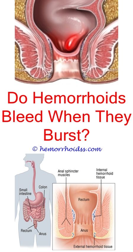 How Long Does It Take For Hemorrhoids To Go Away ...