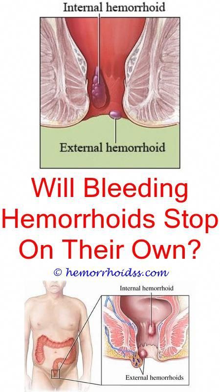 How long does it take to heal from hemorrhoid surgery ...