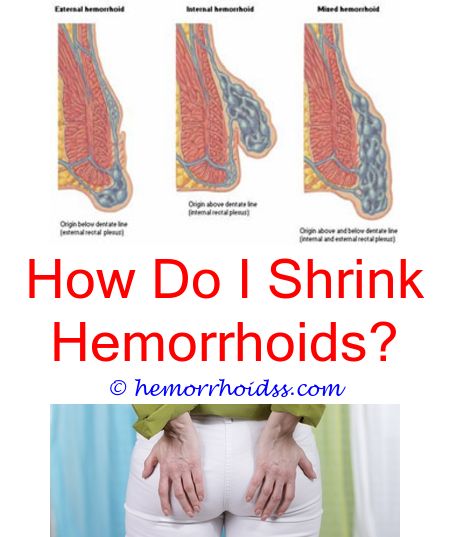 How Long Should Hemorrhoids Last?