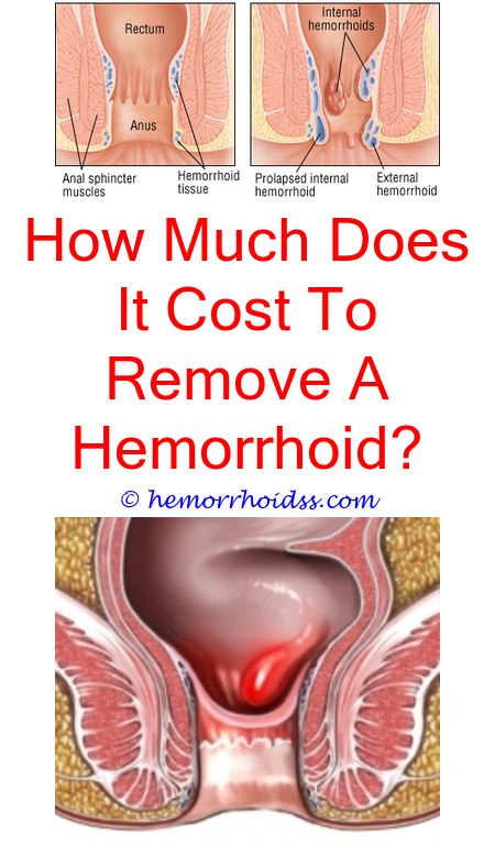 How Much Does It Cost To Get Rid Of A Hemorrhoid  ho ...