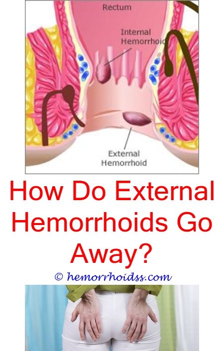 How To Cure Hemorrhoids At Home Fast?
