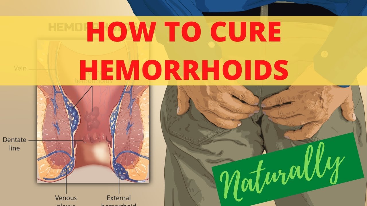 How To Cure Hemorrhoids Naturally