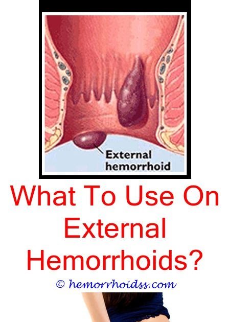 How To Cure Prolapsed Hemorrhoids Naturally? how to care ...