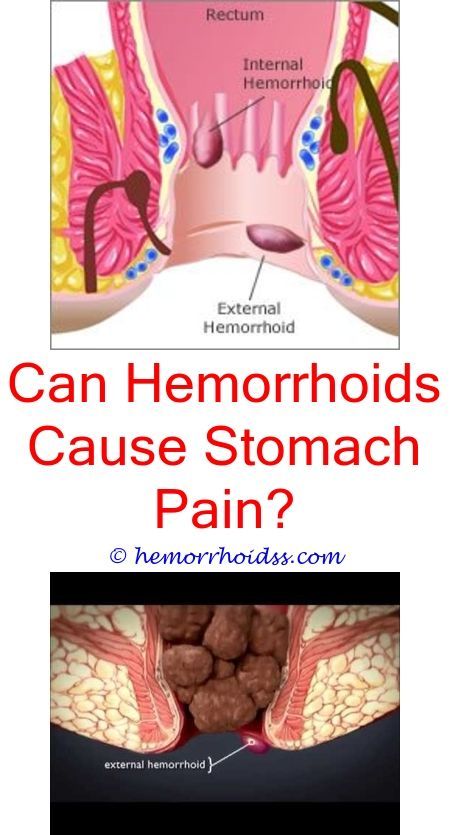 How To Deal With Bleeding Hemorrhoids