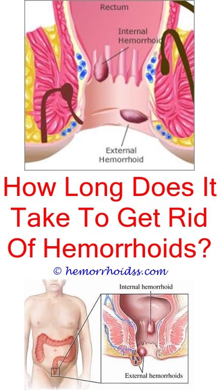 How To Drain External Hemorrhoids? how long does a ...