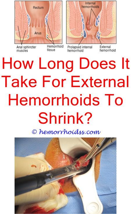 How To Get Hemorrhoids Out Of Your Life