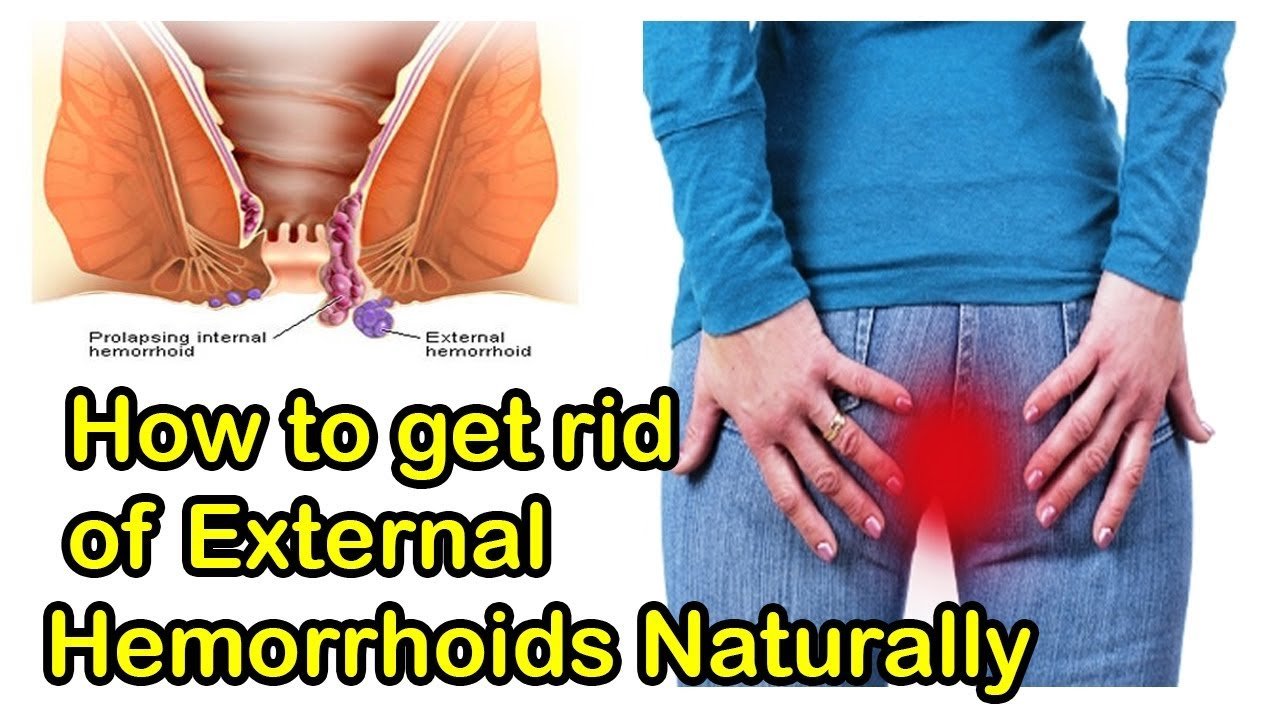 How To Get Rid Of External Hemorrhoids Fast At Home Naturally Without ...