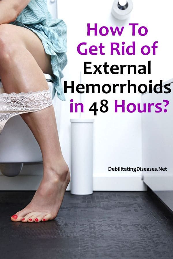 How to Get Rid of External Hemorrhoids in 48 Hours