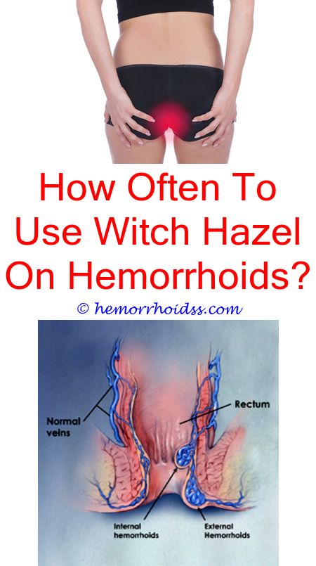 How To Get Rid Of Hemorrhoid Pdf? how long external ...