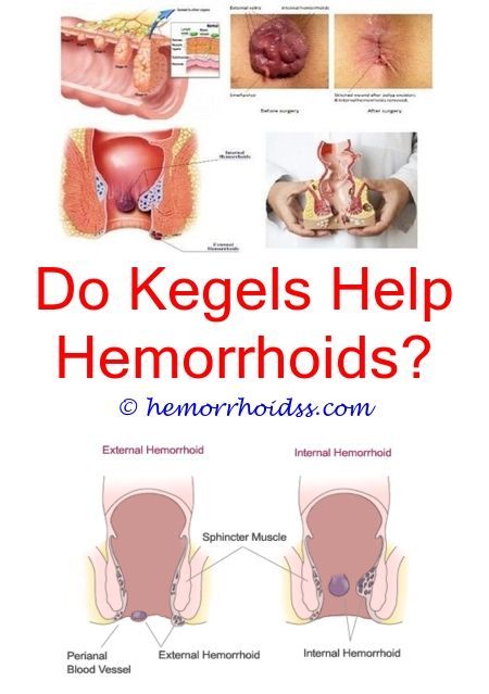 How to get rid of hemorrhoids after birth IAMMRFOSTER.COM