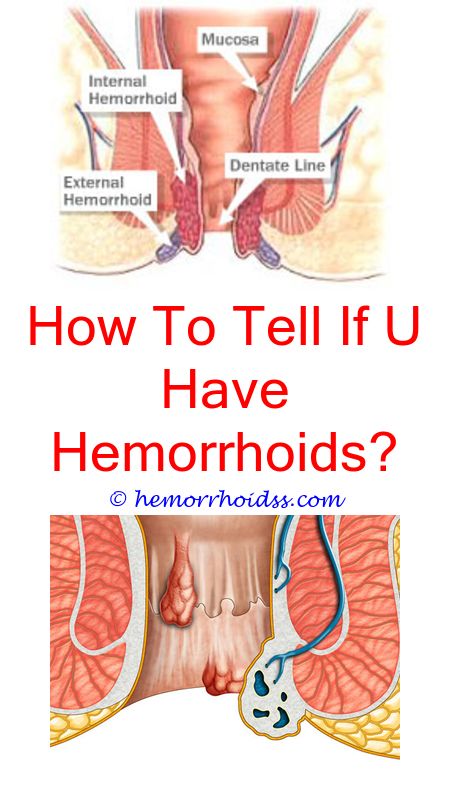 How To Get Rid Of Hemorrhoids Fast?