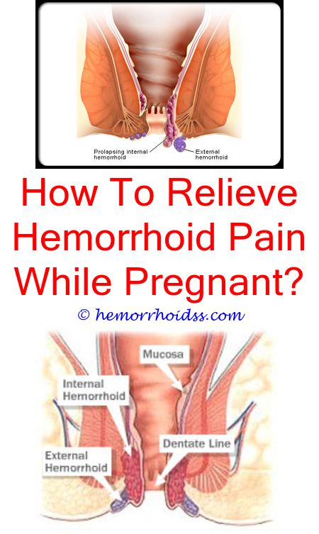 How To Get Rid Of Hemorrhoids Naturally Fast And Easy ...