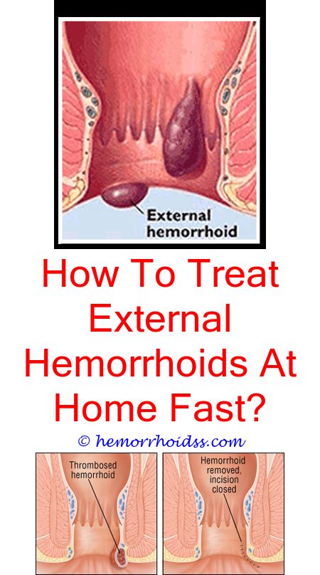 How To Get Rid Of Hemorrhoids Naturally?