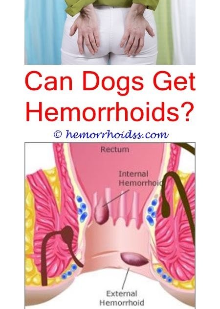 How To Get Rid Of Hemorrhoids Nhs