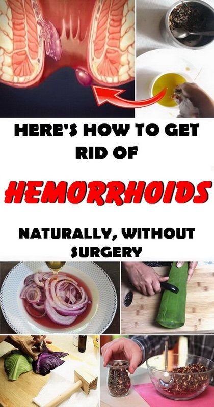 HOW TO GET RID OF HEMORRHOIDS WITH NO SURGERY!