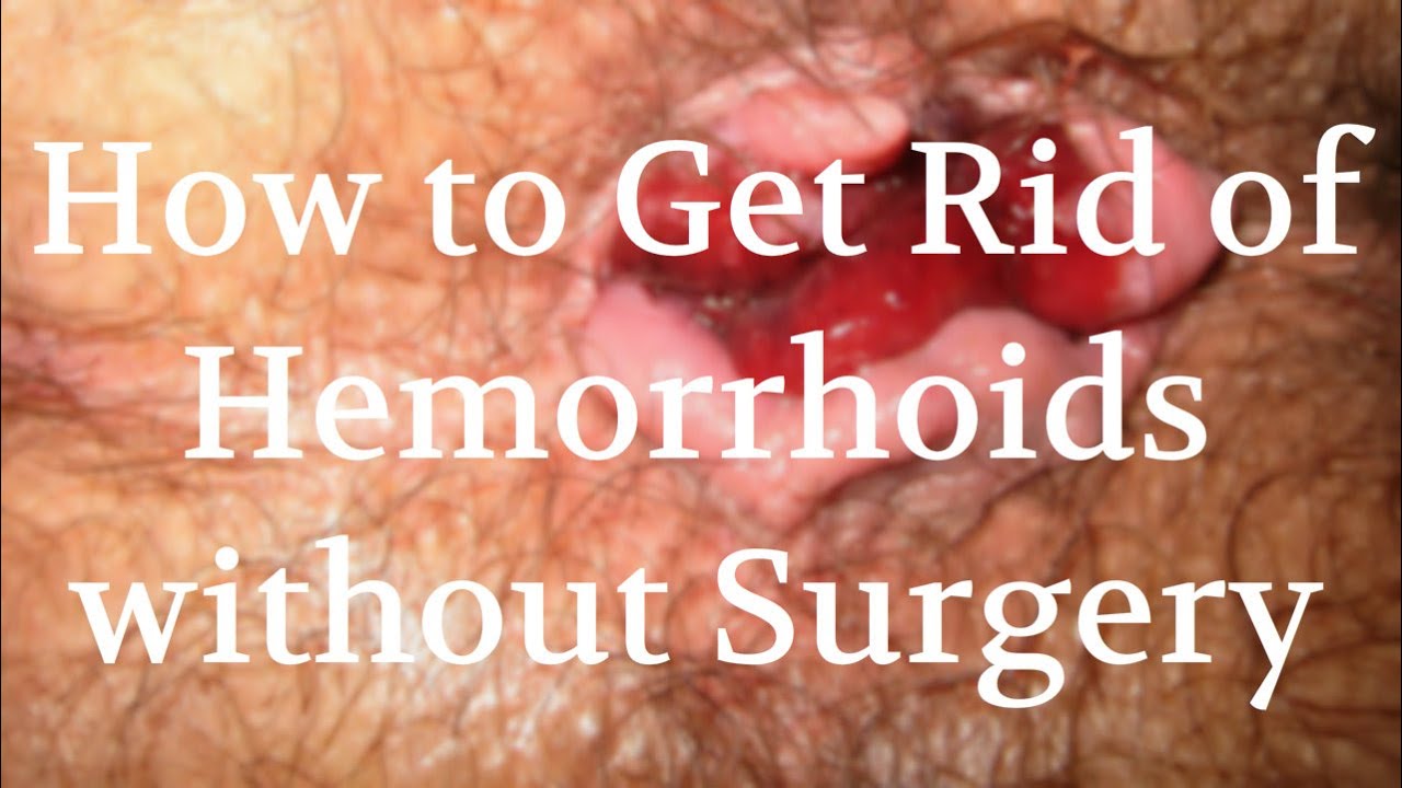 How to Get Rid of Hemorrhoids without Surgery