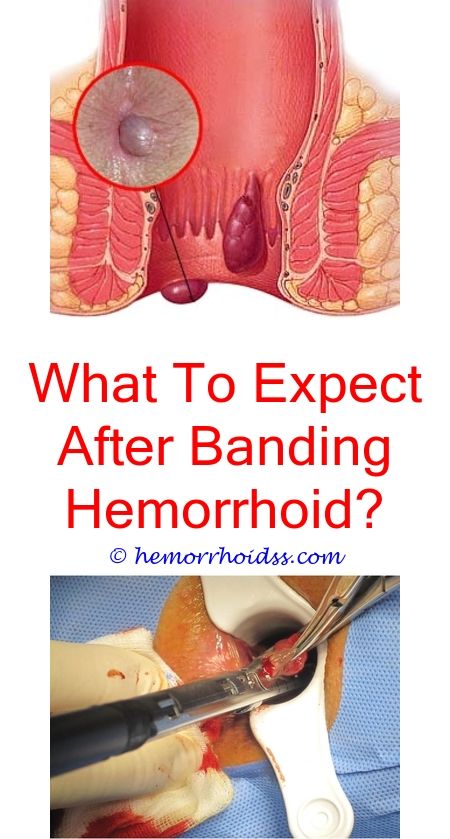 How To Get Rid Of Inner Hemorrhoids? when will my ...