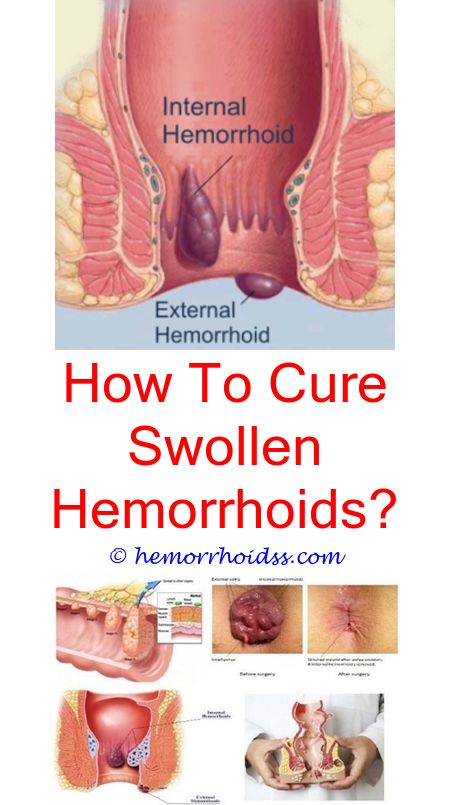 How To Get Rid Of Old Hemorrhoids