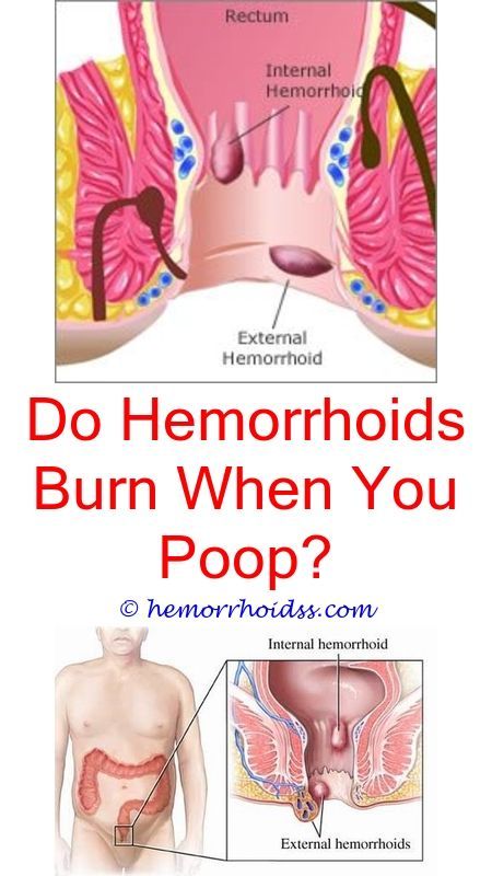 How to heal hemorrhoids without surgery?.How long can ...
