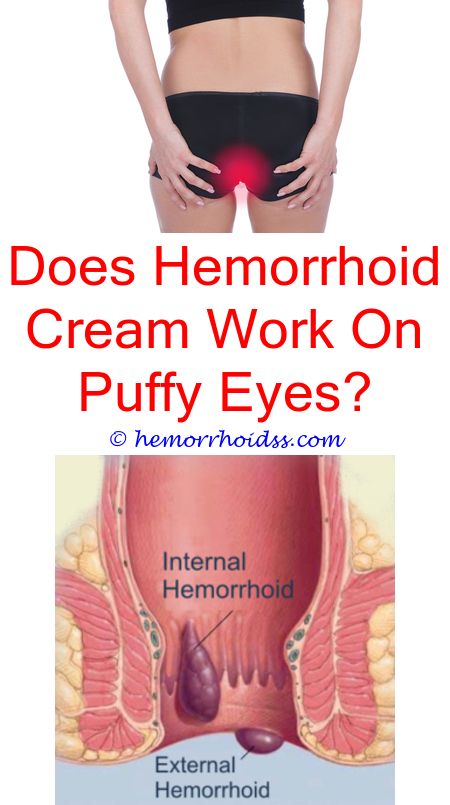How To Know If You Have Hemorrhoids?