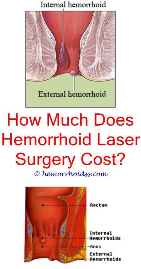 How To Push A Hemorrhoid Back In?