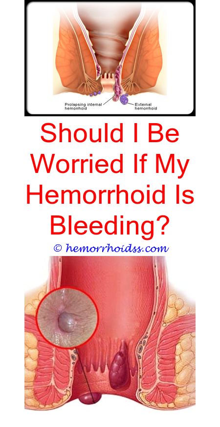 How To Push A Hemorrhoid Back In Video? how do you apply hemorrhoid ...