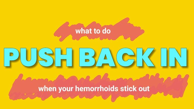 How to Push Back your Hemorrhoids [Step