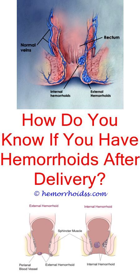 How To Reduce Hemorrhoid Bleeding? how did i get internal ...