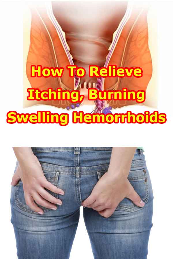 How To Relieve Itching, Burning And Swelling Hemorrhoids ...