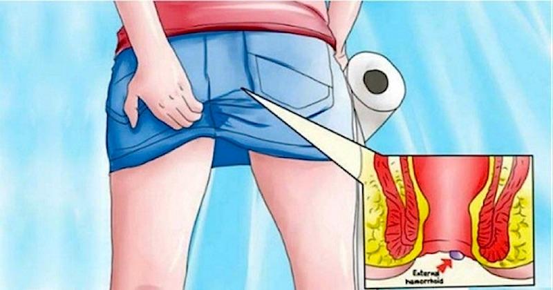 How to Stop Hemorrhoid Itching and Burning
