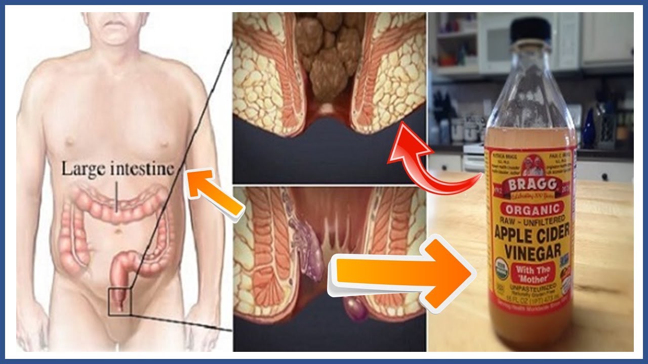 How To Stop Internal Hemorrhoids Bleeding Naturally At Home  The ...