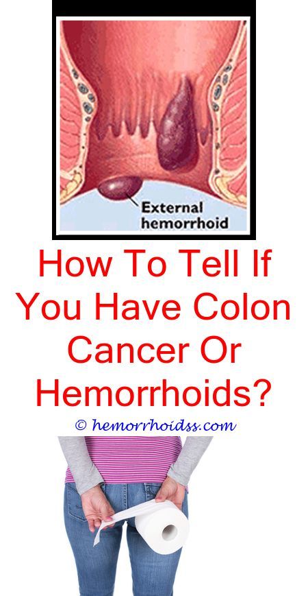 How To Tell If You Have External Hemorrhoids