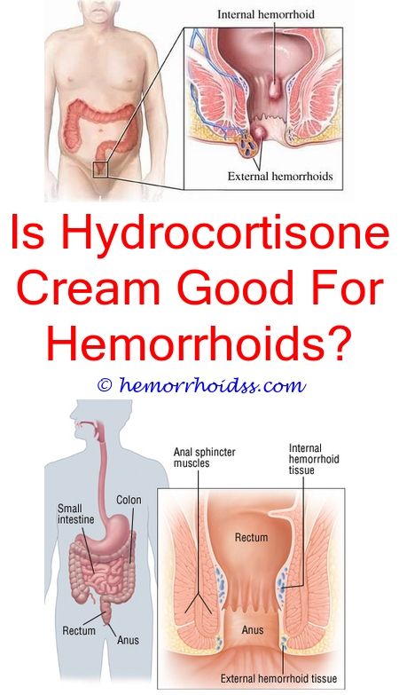 How To Treat A Hemorrhoid Flare Up?