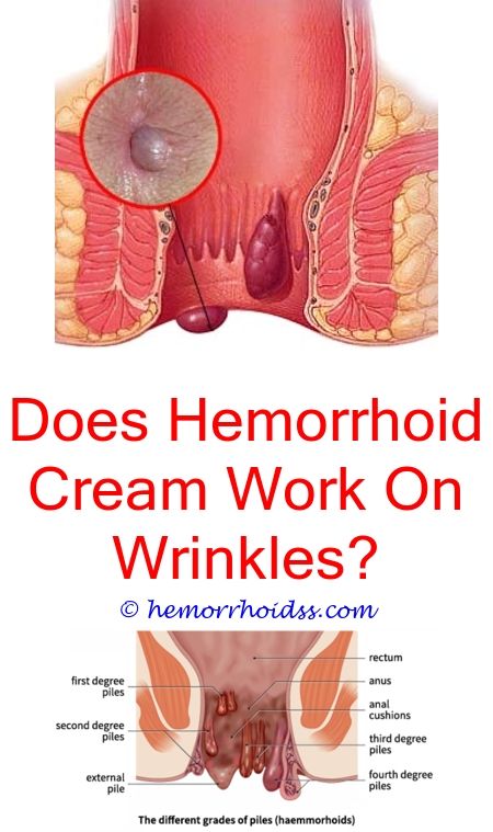 How To Treat External Hemorrhoids At Home?