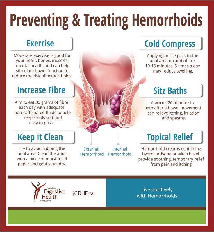 How To Treat Fissures And Hemorrhoids