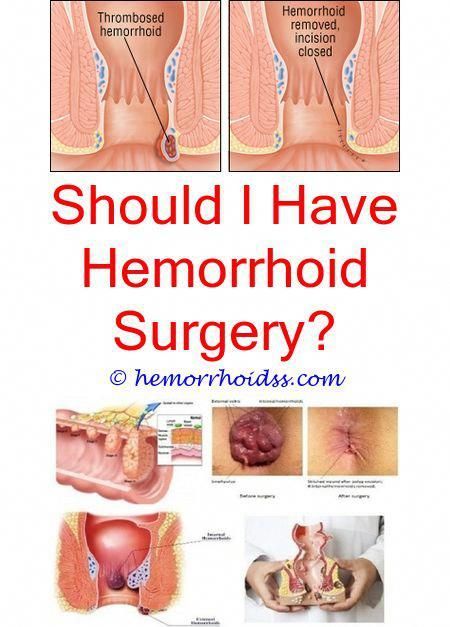 How To Treat Hemorrhoids While Pregnant