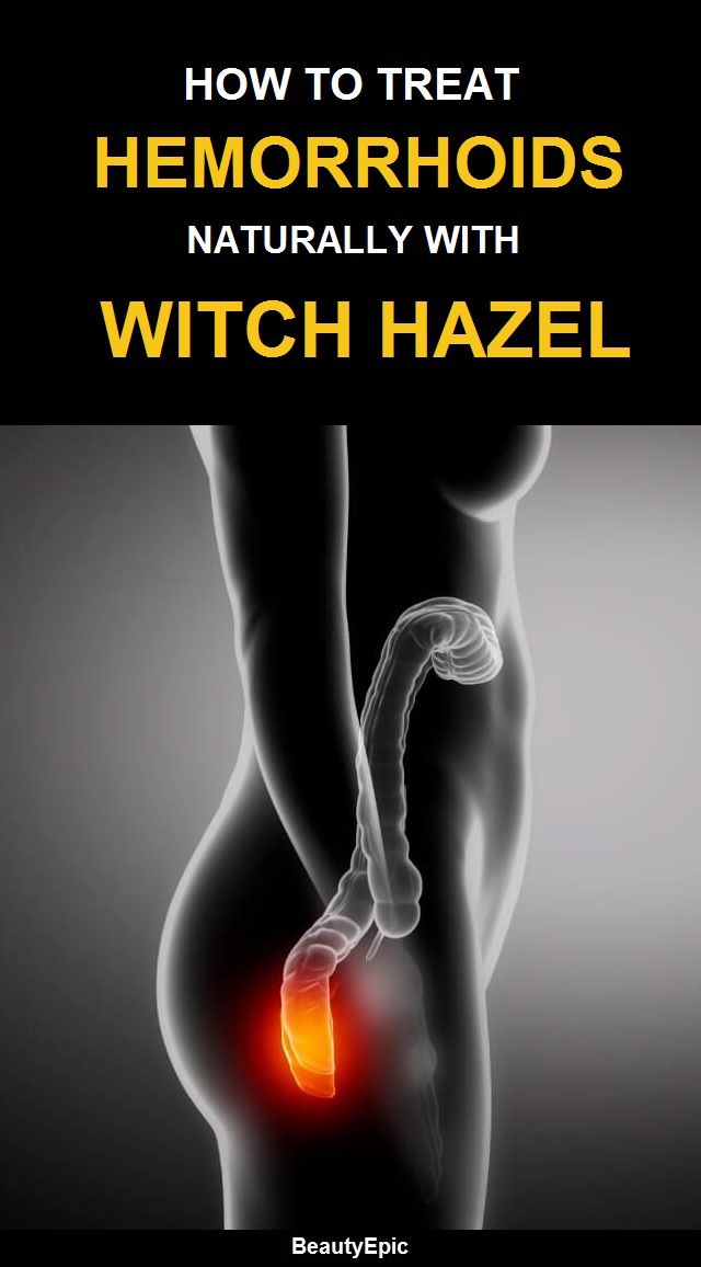 How to Treat Hemorrhoids with Witch Hazel?