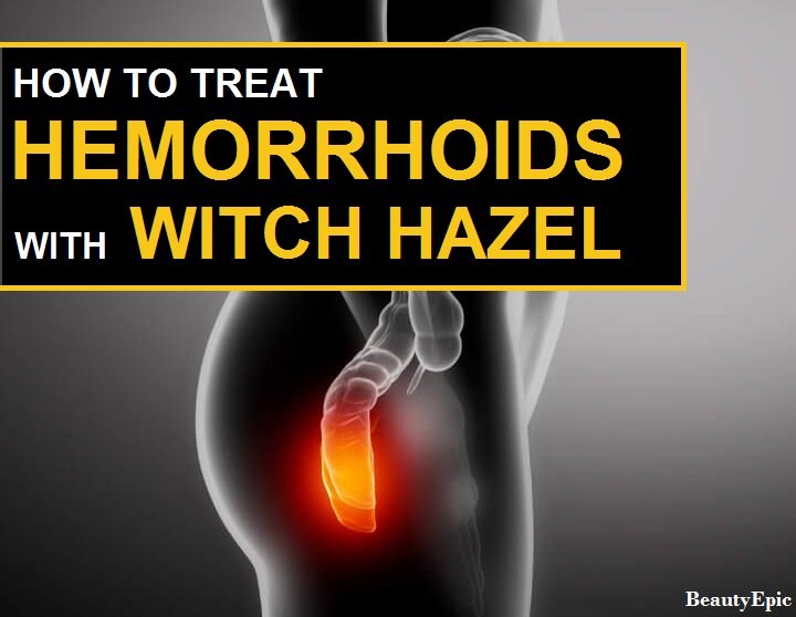 How to Treat Hemorrhoids with Witch Hazel?