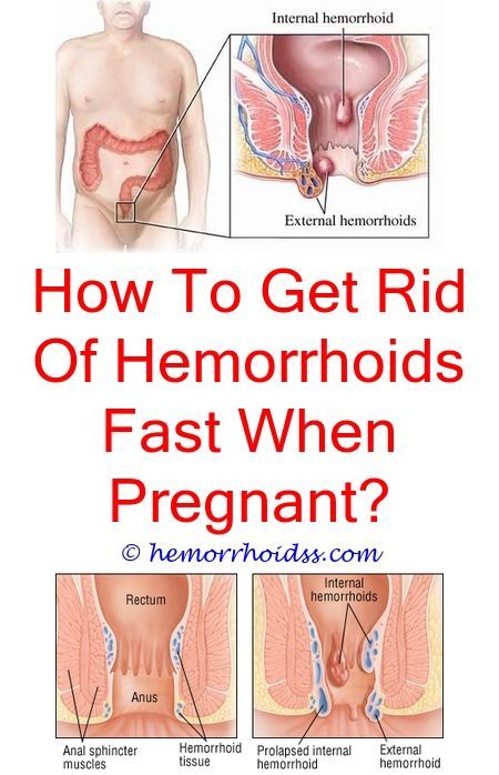 How To Treat Prolapsed Hemorrhoids During Pregnancy  ho ...