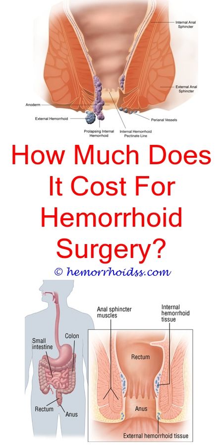 How To Treat Thrombosed Hemorrhoids? (With images ...