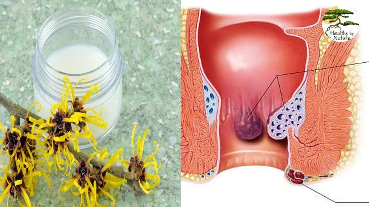 How To Use Witch Hazel For Hemorrhoids