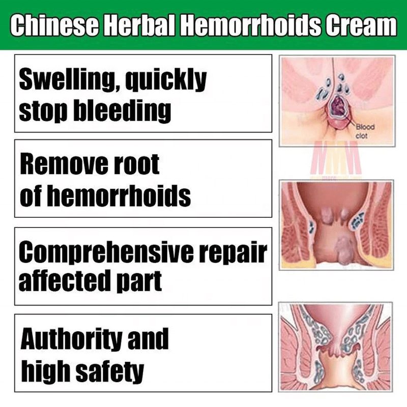 Hua Tuo Herbal Hemorrhoids Cream Chinese Healthy Cream For Internal ...