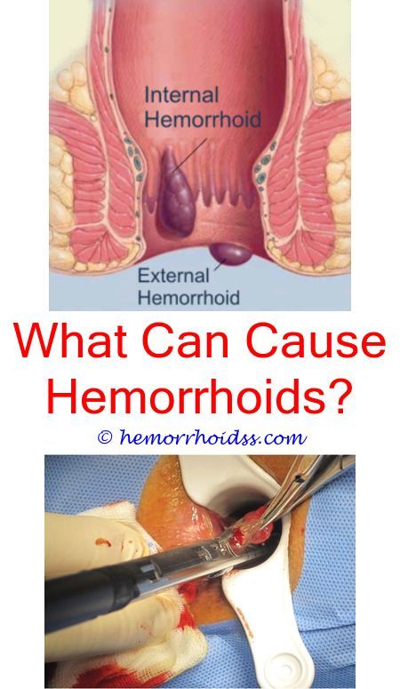 #internal #hemorrhoids how long does a prolapsed ...