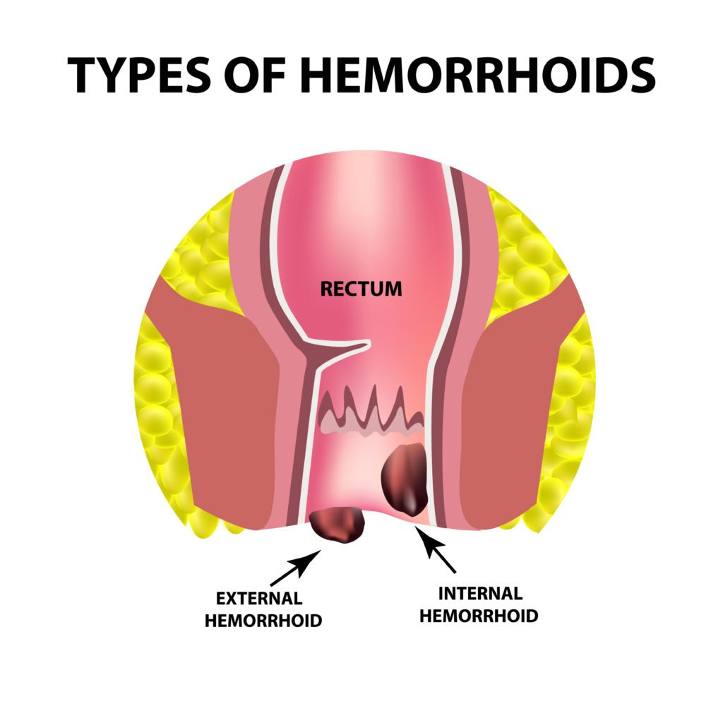 Internal Hemorroids: What Are They &  What Are My Options ...