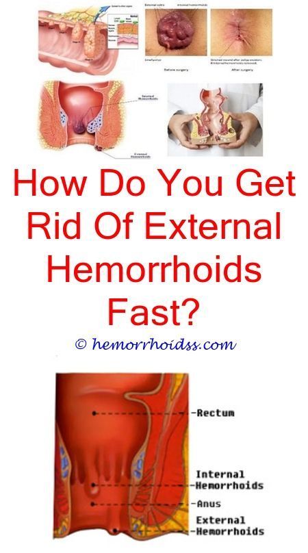 Is hemorrhoid cream over the counter?.What can you take ...
