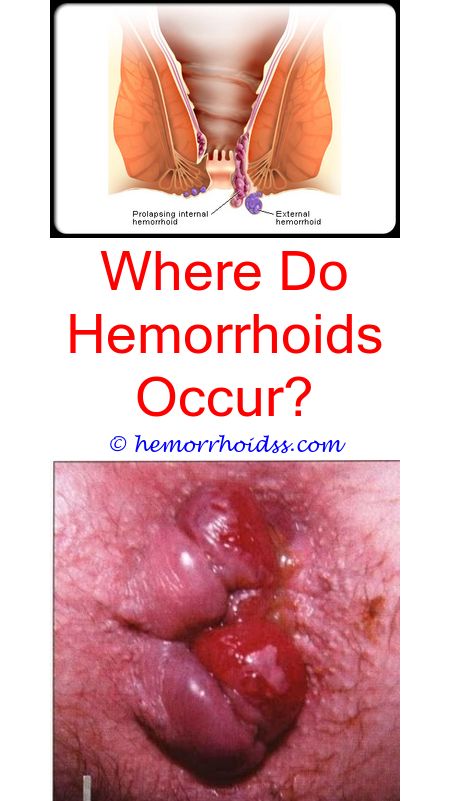 Is It A Hemorrhoid Or A Polyp?